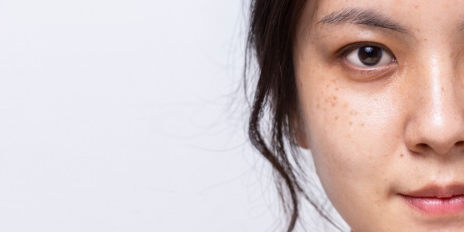 Ini 11 Cara Menghilangkan Flek Hitam di Wajah Secara Alami